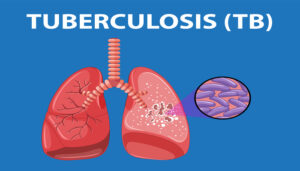 Mycobacterium tuberculosis